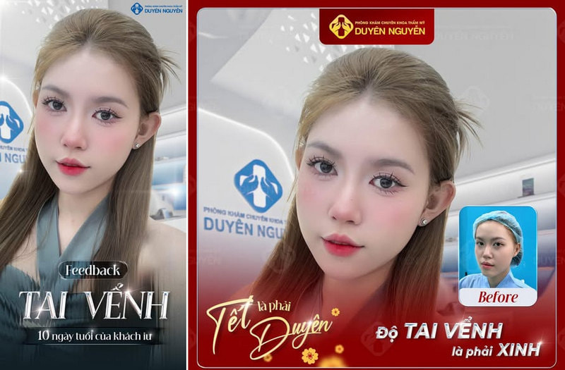 Gương mặt hài hòa nhờ phẫu thuật tai vểnh
