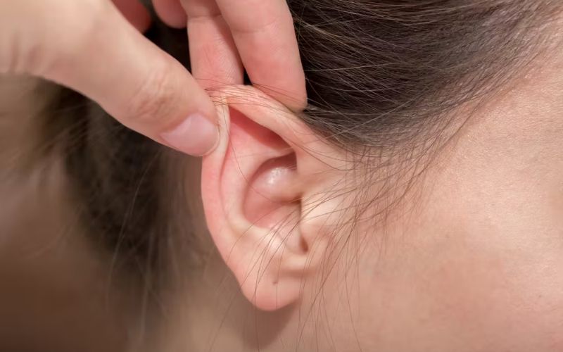 Sẹo mờ sau khi phẫu thuật tai vểnh