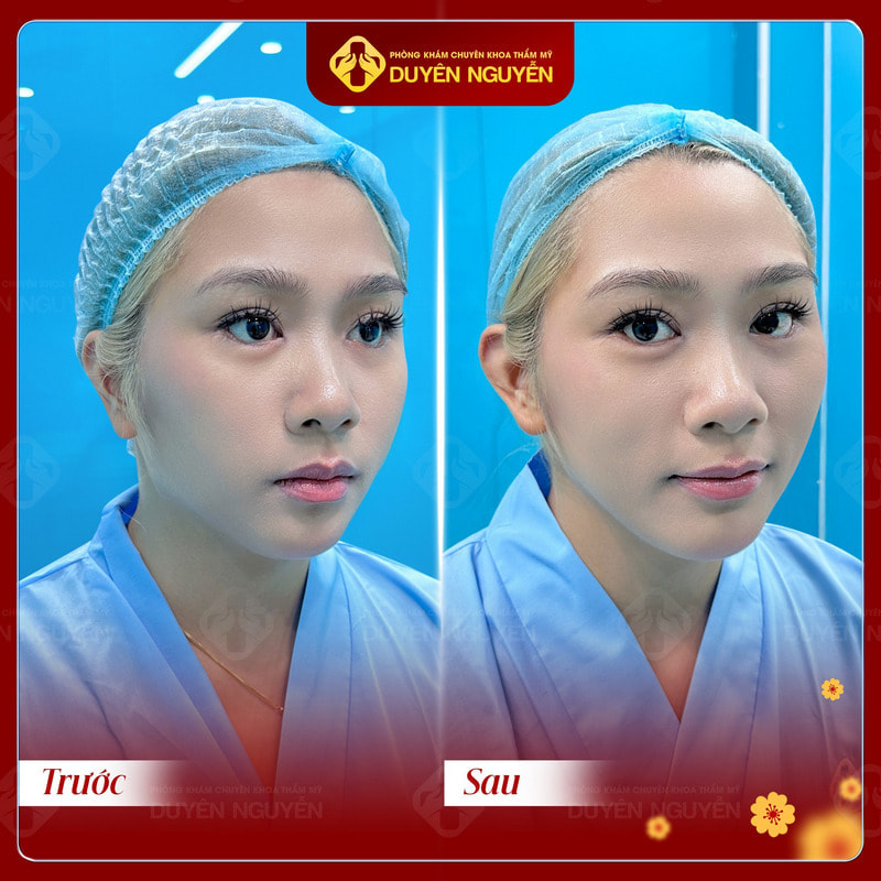 Dáng tai vểnh được thực hiện bởi Phòng khám Duyên Nguyễn