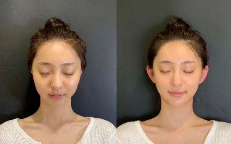 Phẫu thuật tai vểnh giúp gương mặt thêm hài hòa