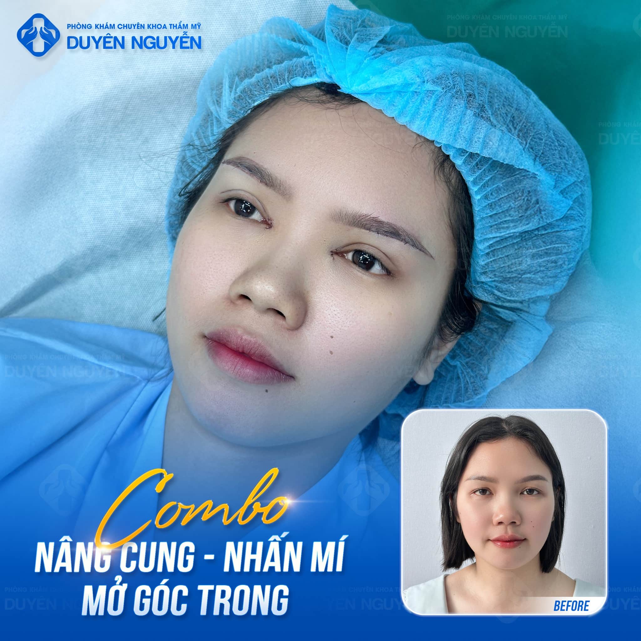 Hình khách nâng cung - nhấn mí và mở góc mắt trong tại Phòng khám Duyên Nguyễn