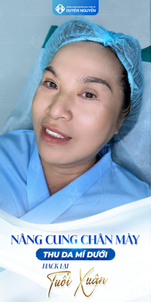 Phẫu thuật nâng cung mày tại Phòng khám Duyên Nguyễn