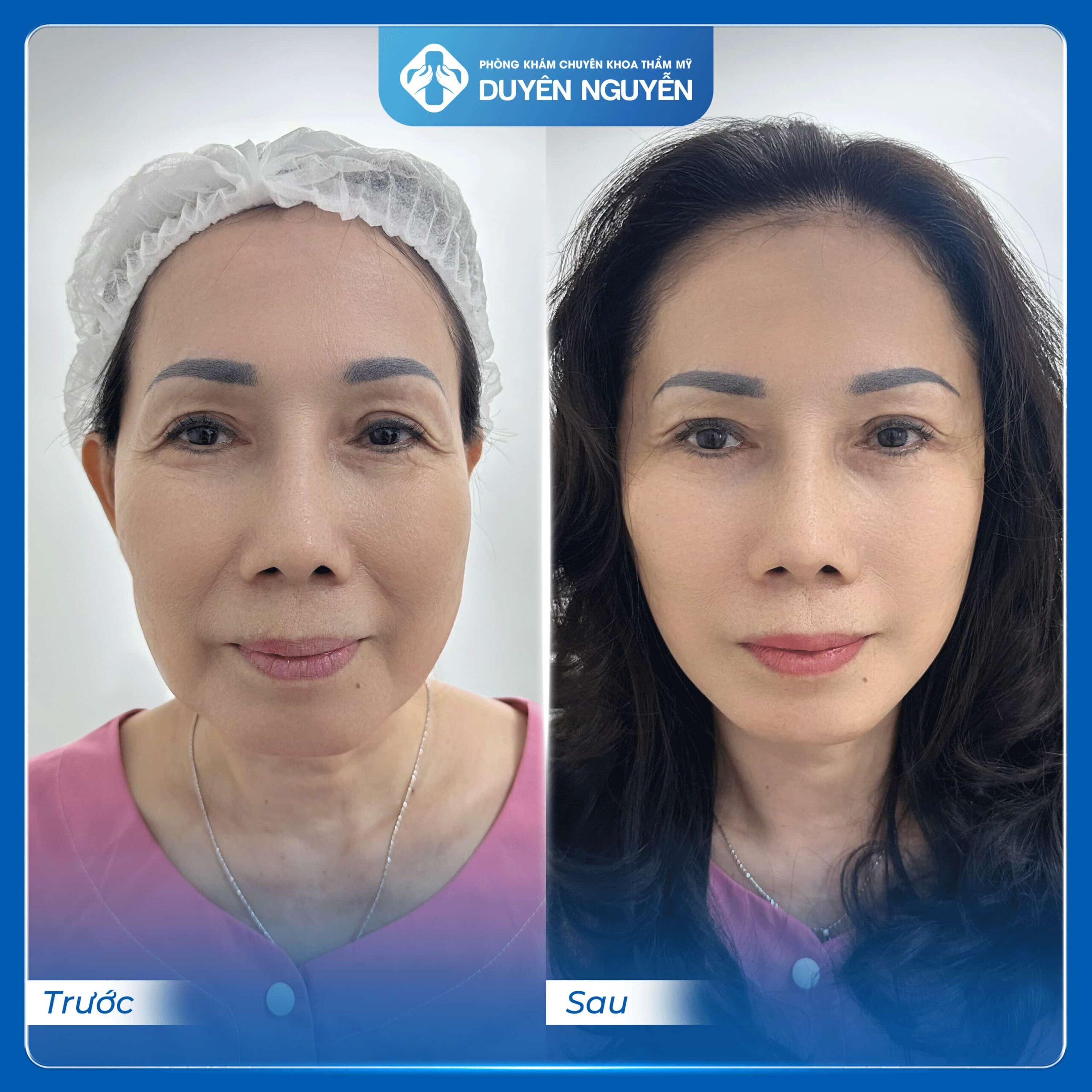 Căng da mặt toàn phần là bí quyết cho khuôn mặt trẻ trung