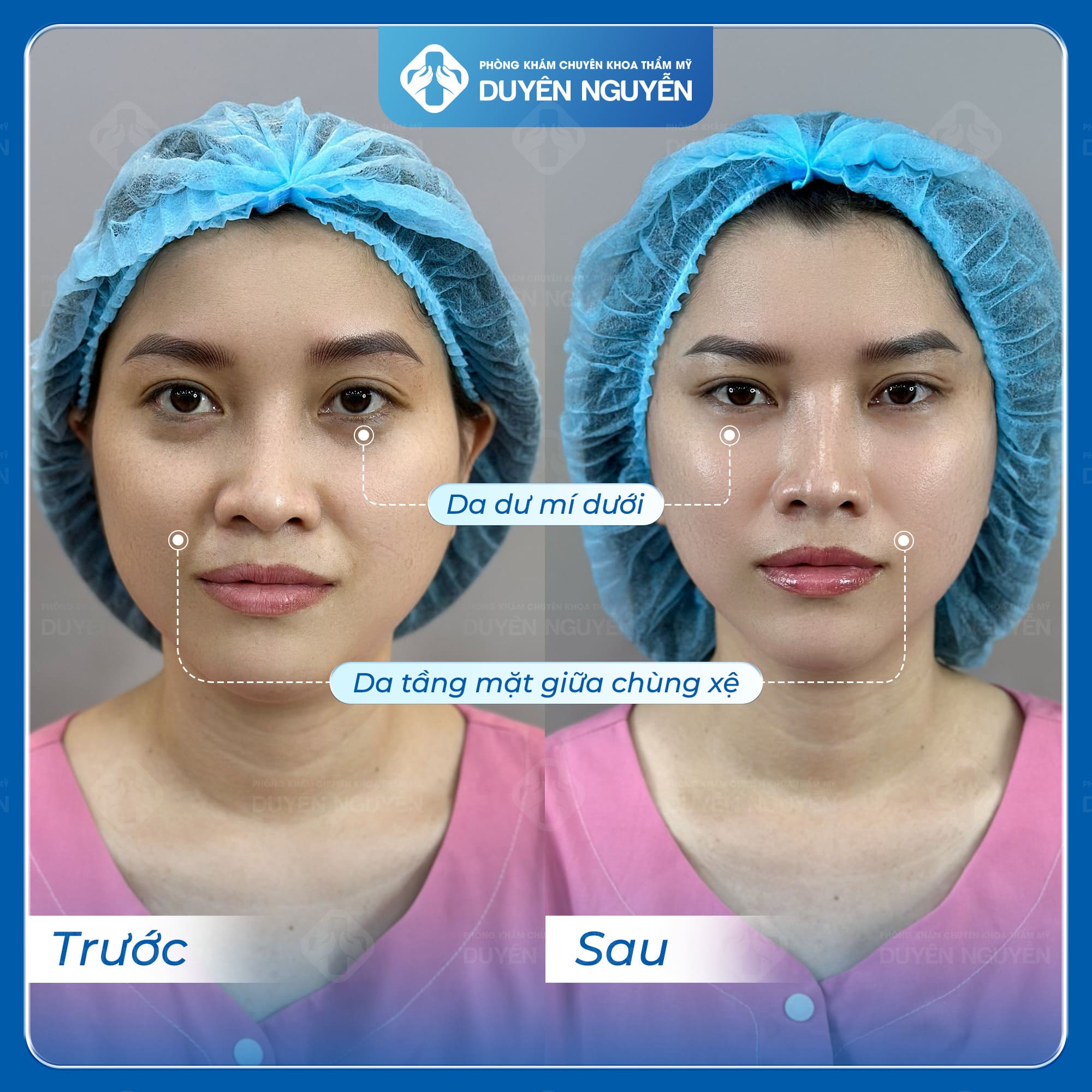 Các nhược điểm trên gương mặt được khắc phục hiệu quả sau căng da mặt