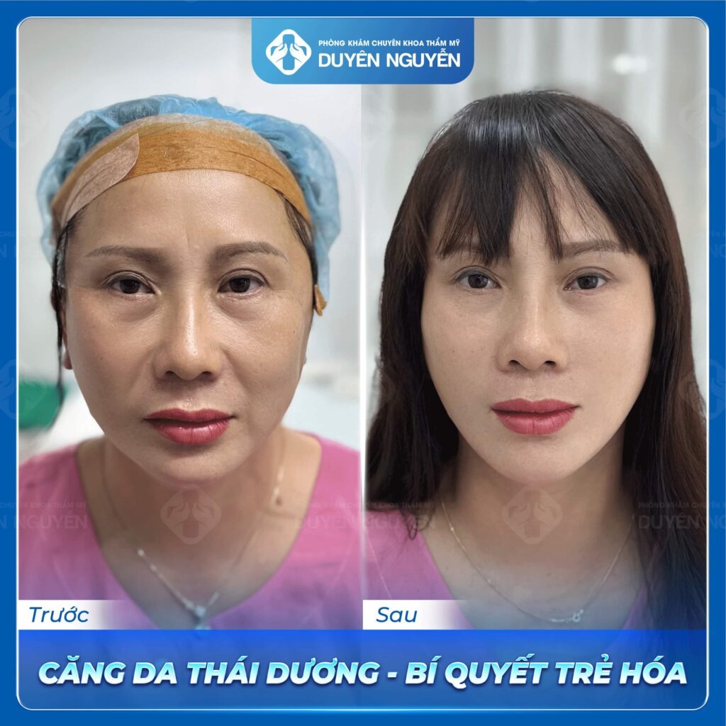 Căng da thái dương giúp trẻ hóa hiệu quả