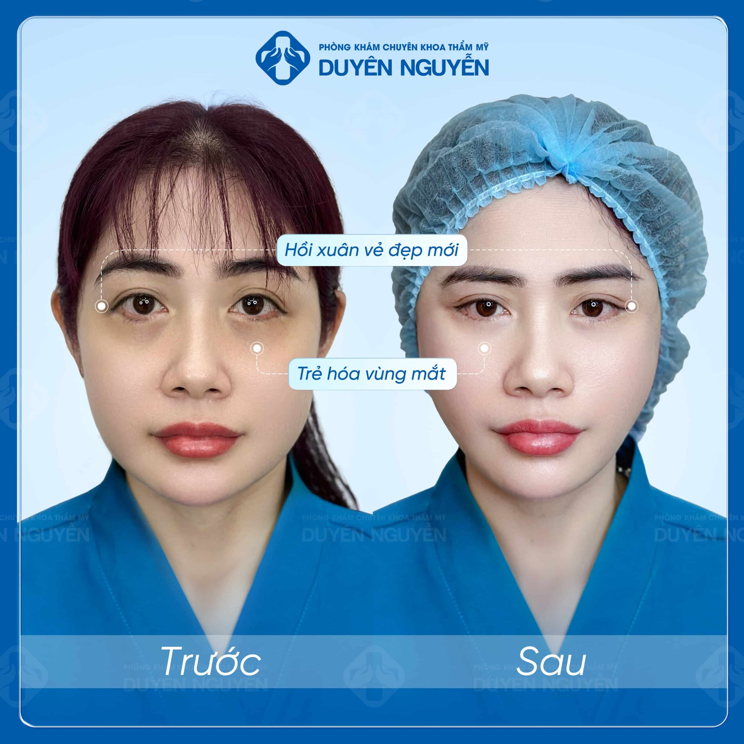 Căng da mặt không gây nhiều đau đớn, có thời gian hồi phục nhanh