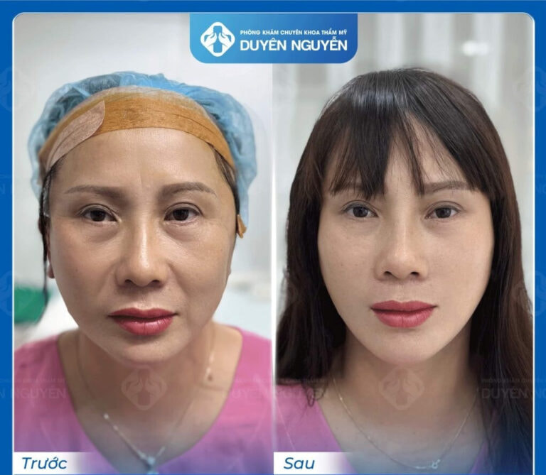 Căng da mặt nội soi giúp căng mịn da, săn chắc tầng mặt giữa