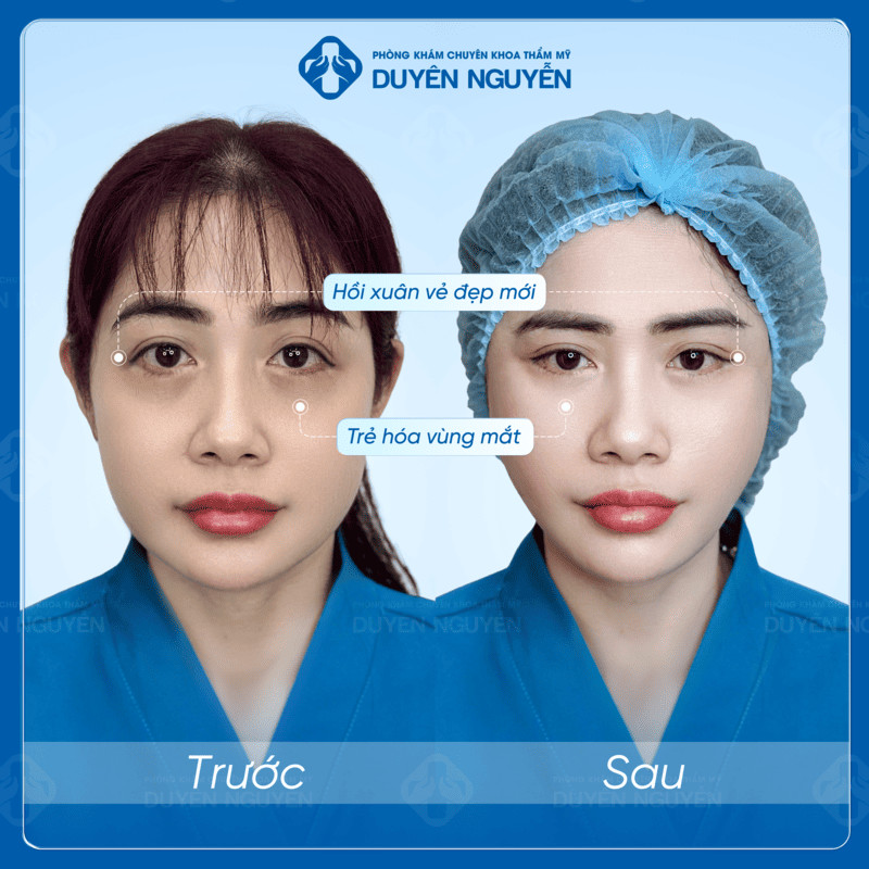 Hạ lệ Trung Hoa giúp trẻ hóa vùng mắt