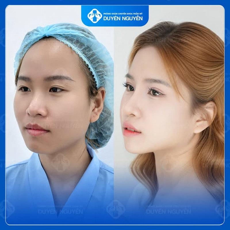 Hạ mắt giọt lệ tạo sự cân đối cho gương mặt