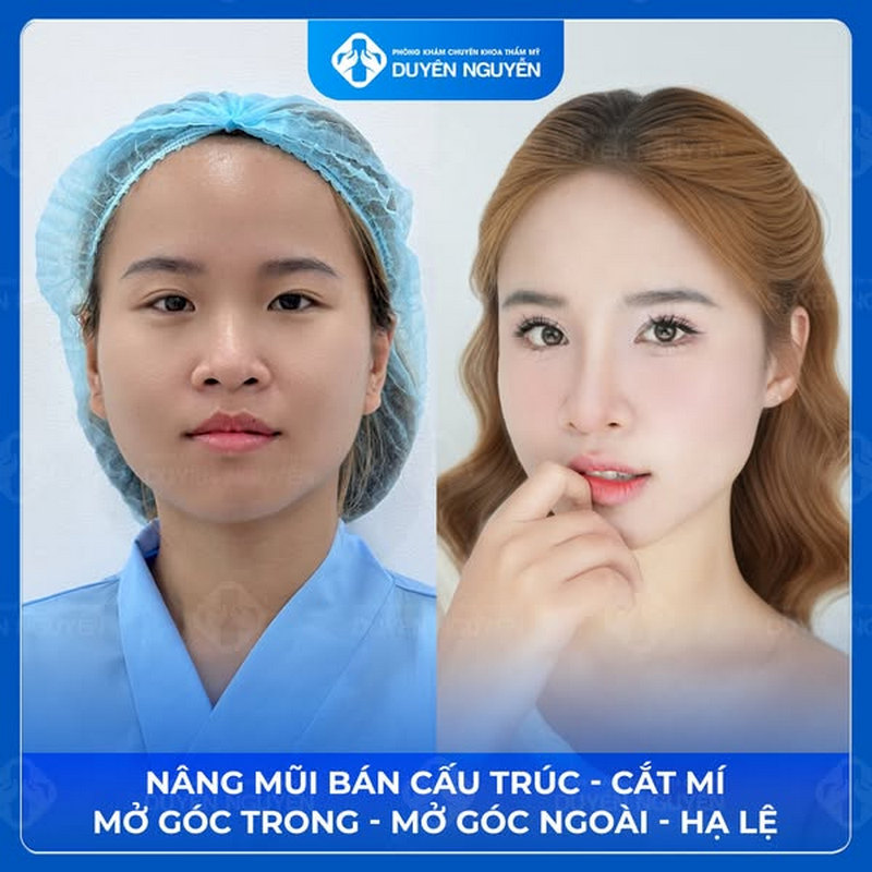 Hạ lệ mắt giúp đôi mắt trở nên trong trẻo và mềm mại