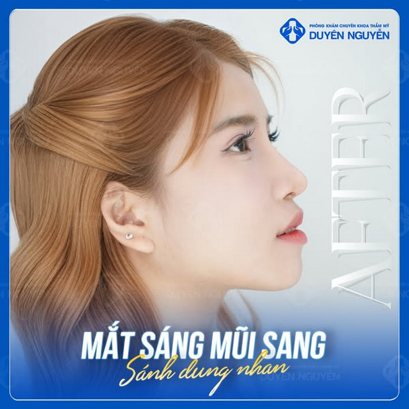 Hạ mắt giọt lệ tuyệt đẹp tại Phòng khám Duyên Nguyễn