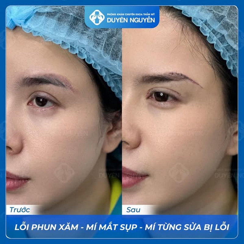 Nâng cung mày an toàn, không đau, cải thiện tình trạng mí sụp