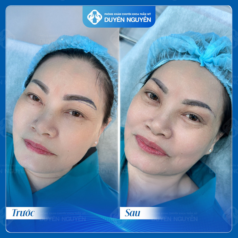 Nâng cung mày giúp đôi mắt to hơn