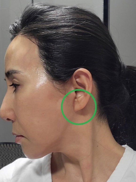 Khách bị dái tai nhọn do căng da mặt SMAS không đúng kỹ thuật