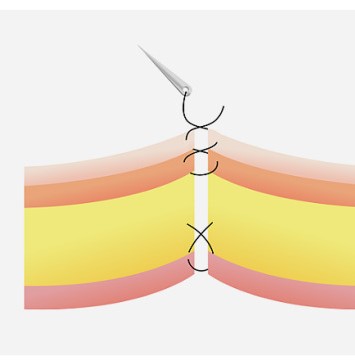 Kỹ thuật khâu riêng từng lớp trong căng da mặt SMAS: Lớp da / Lớp SMAS / Lớp chân bì