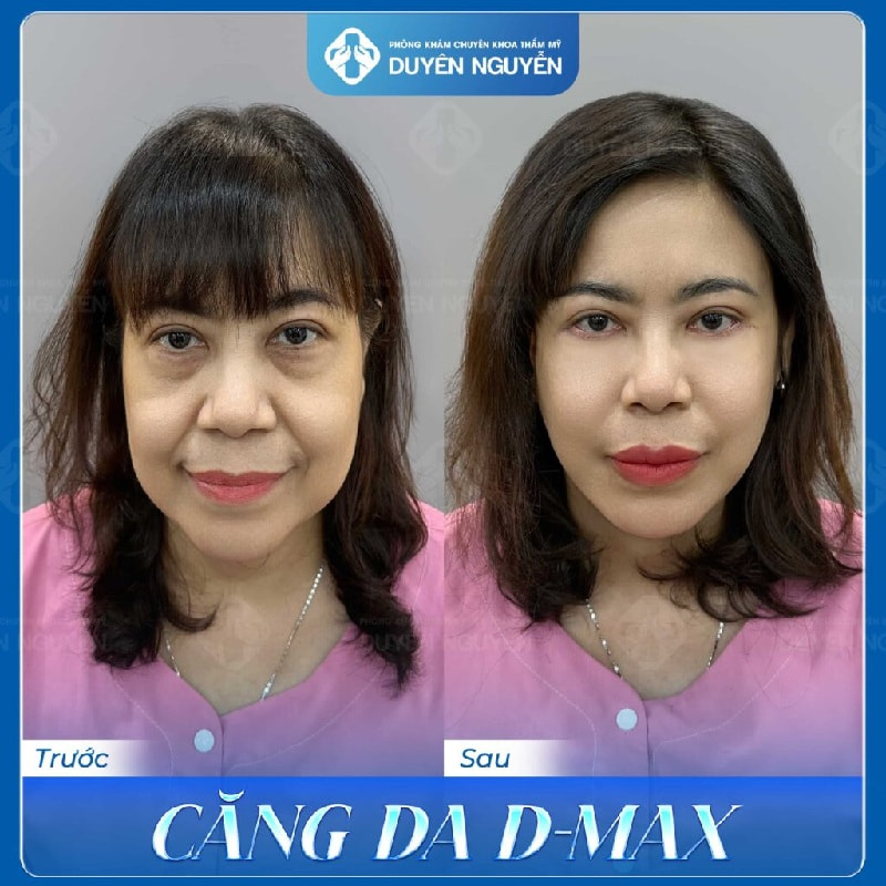 Căng da mặt D-MAX