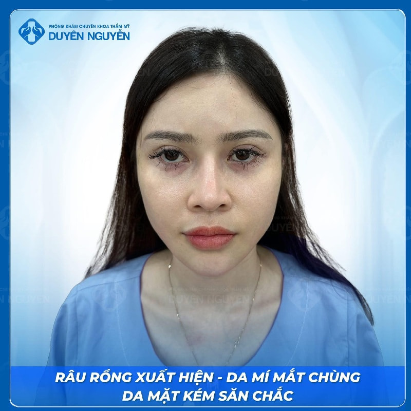 Người có dấu hiệu lão hóa, da mặt kém săn chắc nên cân nhắc căng da