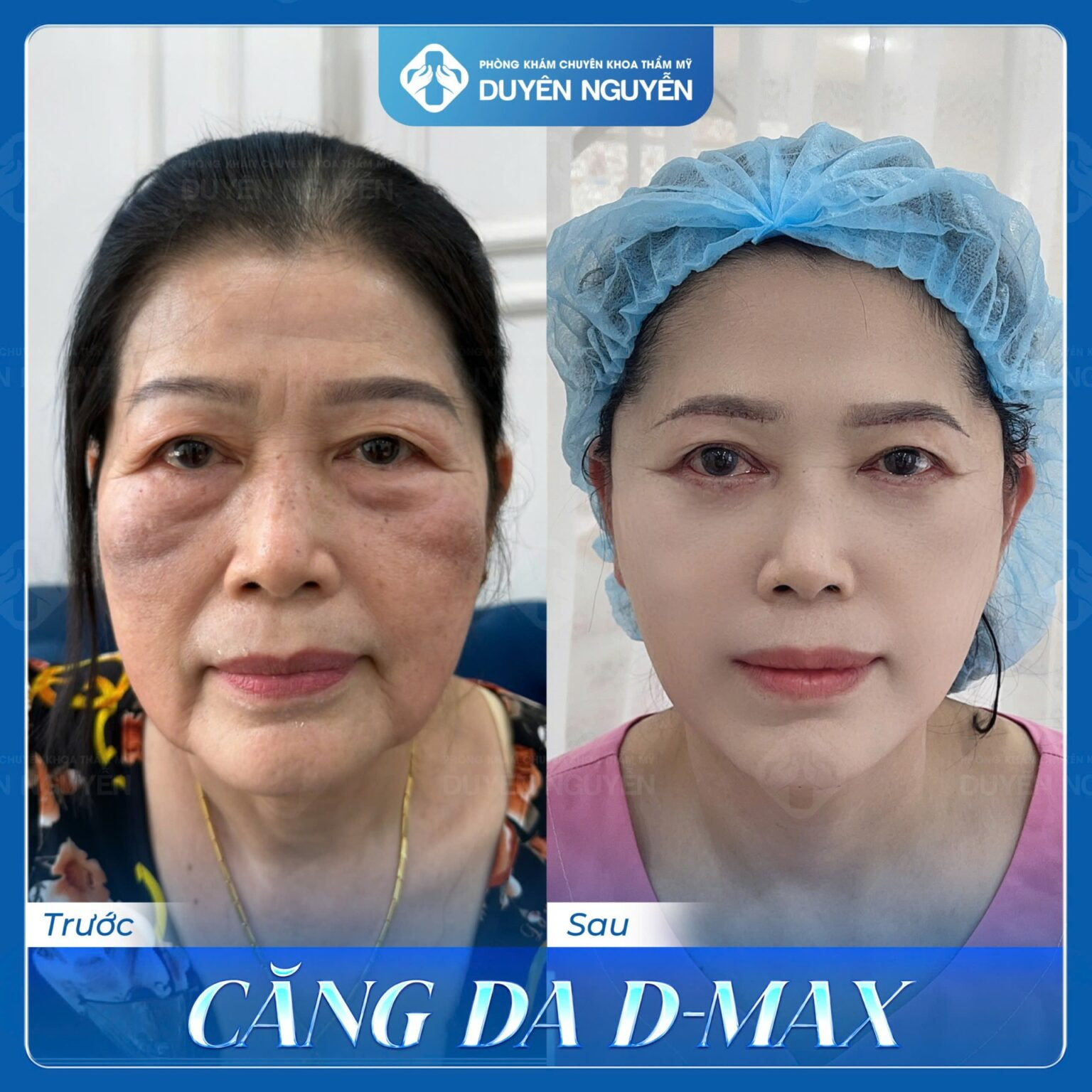 Cô L.B - 55 tuổi, gương mặt thon gọn, rạng ngời như hồi xuân