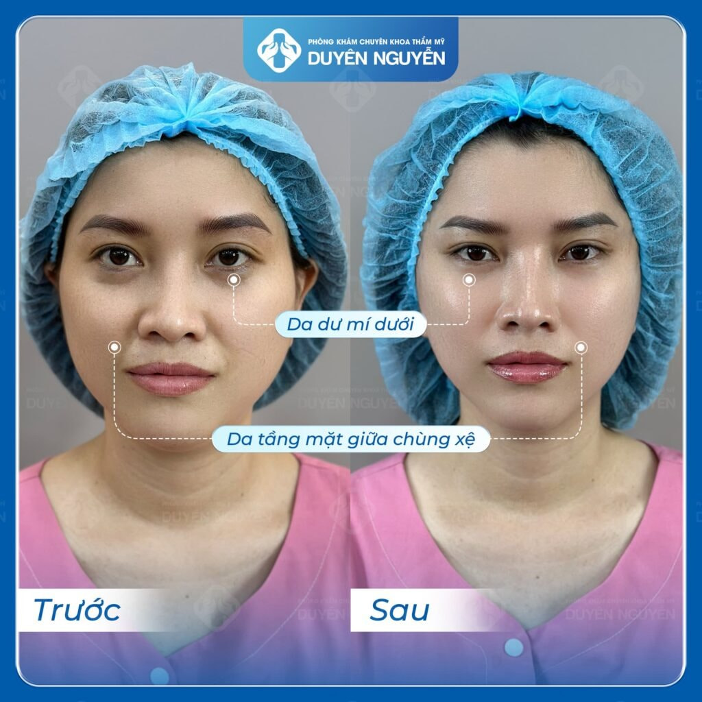 Chị Minh trước và sau khi thực hiện căng da mặt tại phòng khám Duyên Nguyễn