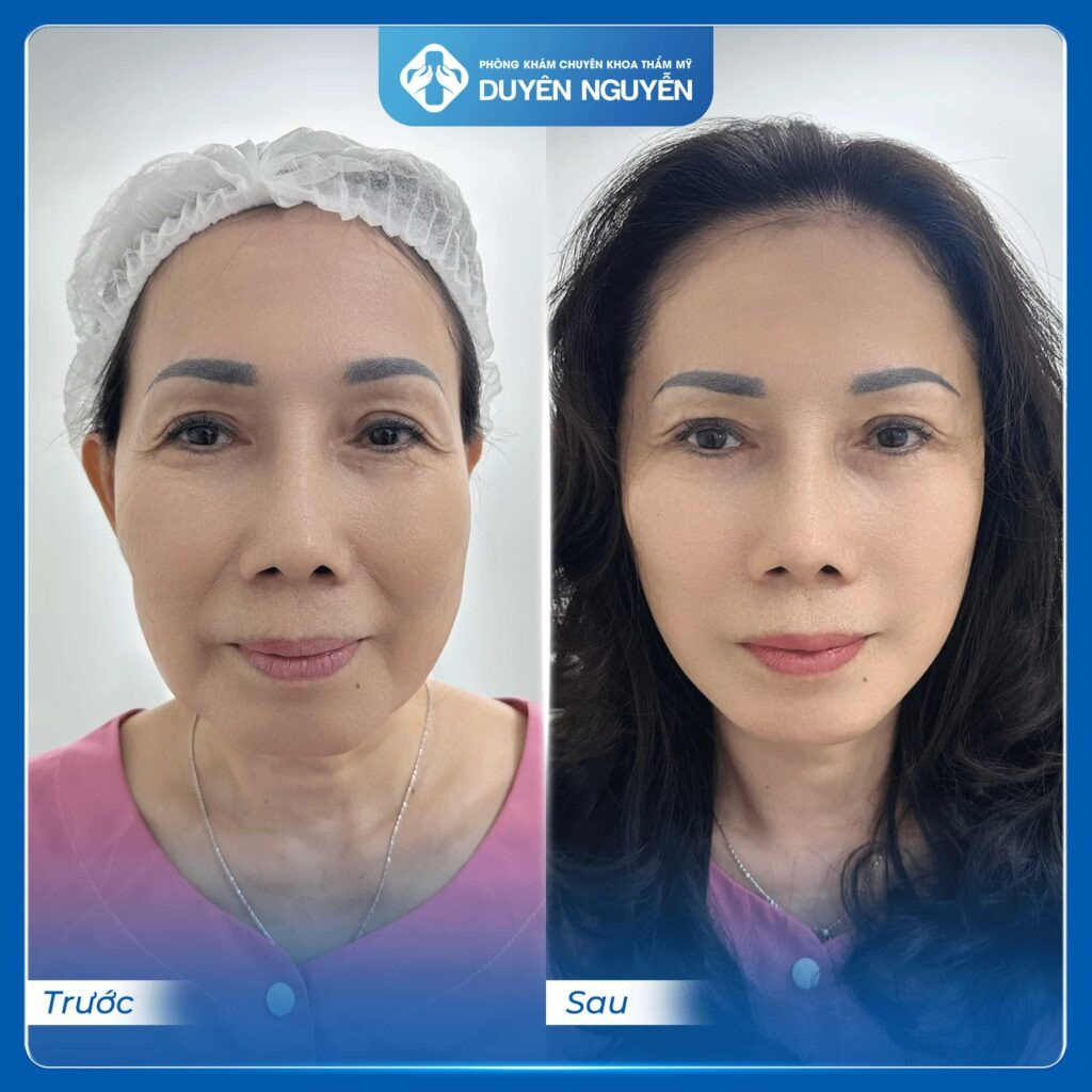 Khách hàng trung niên sau căng da kết quả khác biệt rõ rệt