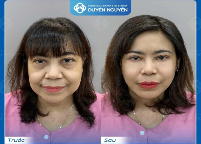 Khuôn mặt trẻ trung, tươi tắn hơn trông thấy sau phẫu thuật căng da Dmax