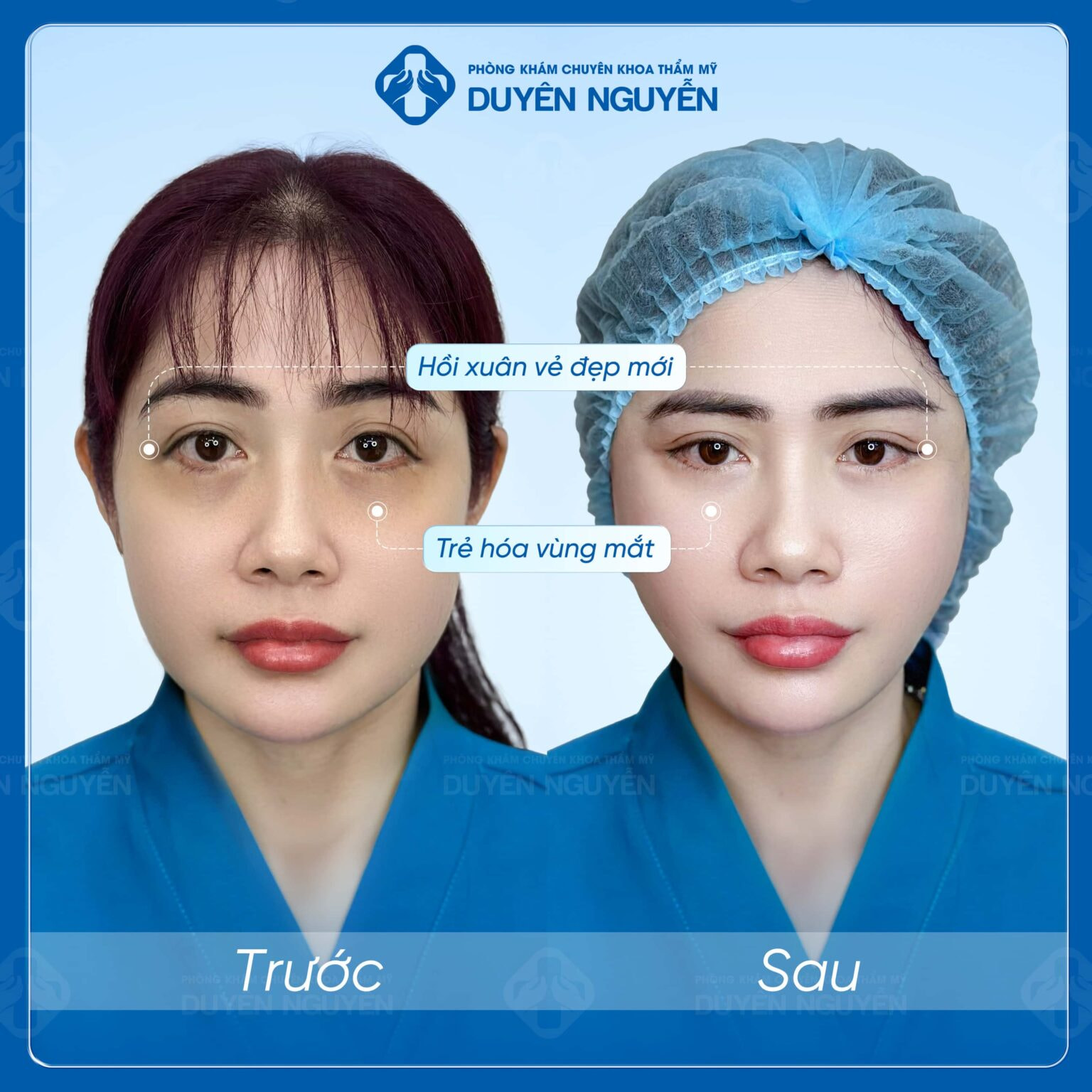 Sự khác biệt của khách hàng khi căng da mặt tại phòng khám Duyên Nguyễn