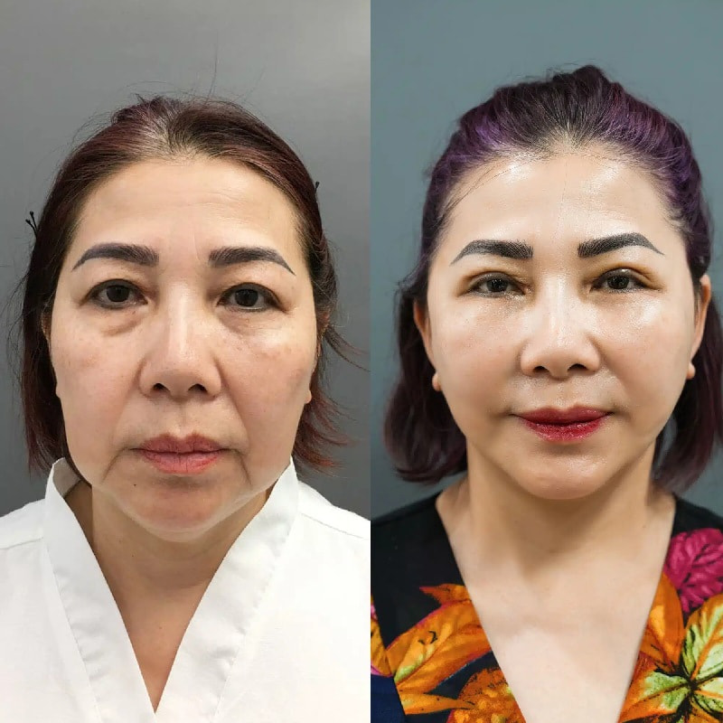 Căng da mặt hiện là phương pháp làm đẹp được nhiều chị em tin chọn