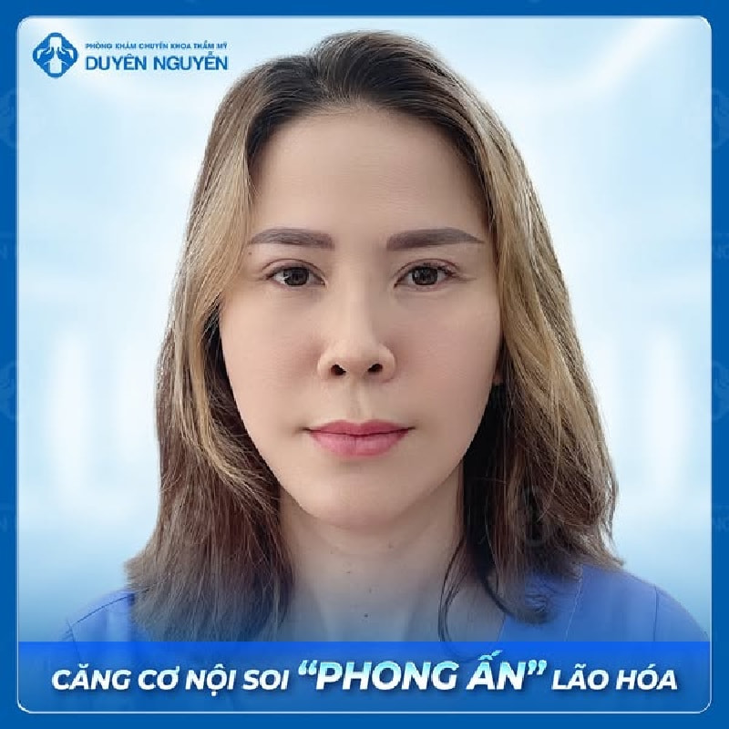 Chị H.M căng da nội soi giúp da mặt căng mịn, nếp nhăn mờ đi