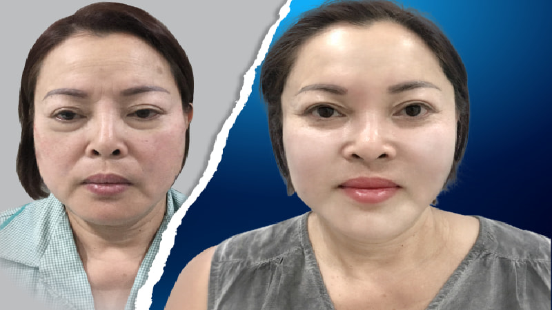 Bạn có thể tìm địa chỉ căng da mặt uy tín qua tham khảo các khách hàng đã từng thực hiện