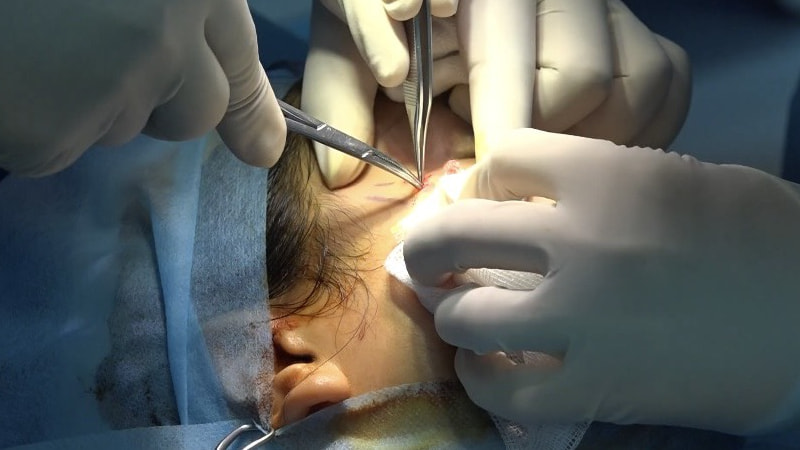 Tiến hành gây mê gây tê sau đó thực hiện căng da mặt