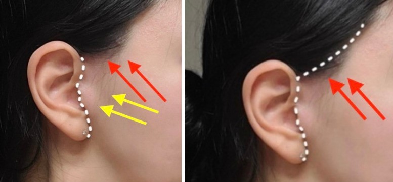 Kỹ thuật giấu sẹo khi thực hiện căng da mặt SMAS