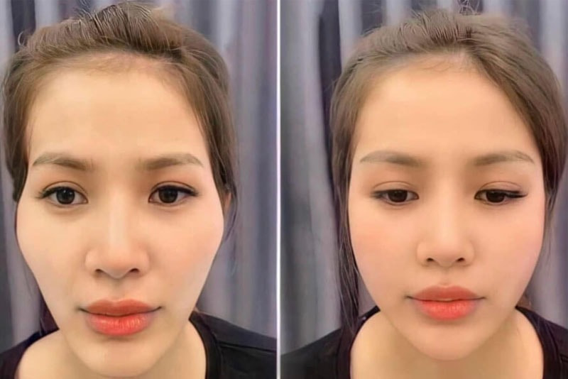 Da mặt vết nám, mẩn đỏ và tàn nhang già trước tuổi