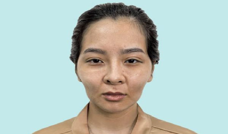 Má hóp, thái dương lõm và rãnh cười sâu già trước tuổi