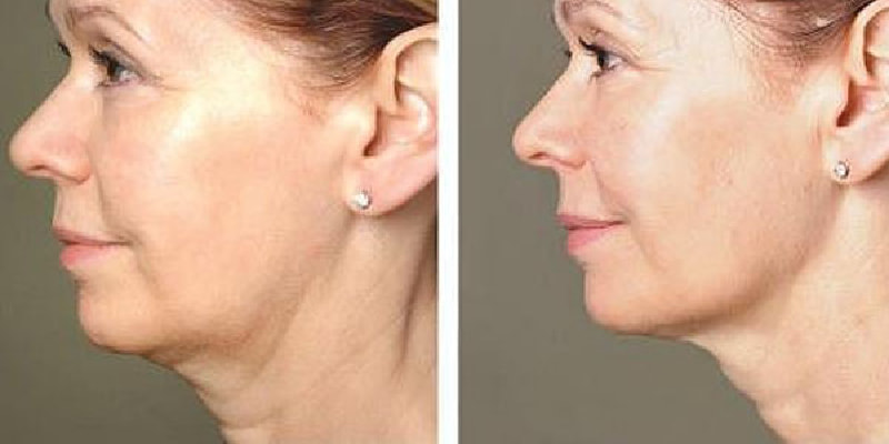 Da trùng nhão không săn chắc già trước tuổi