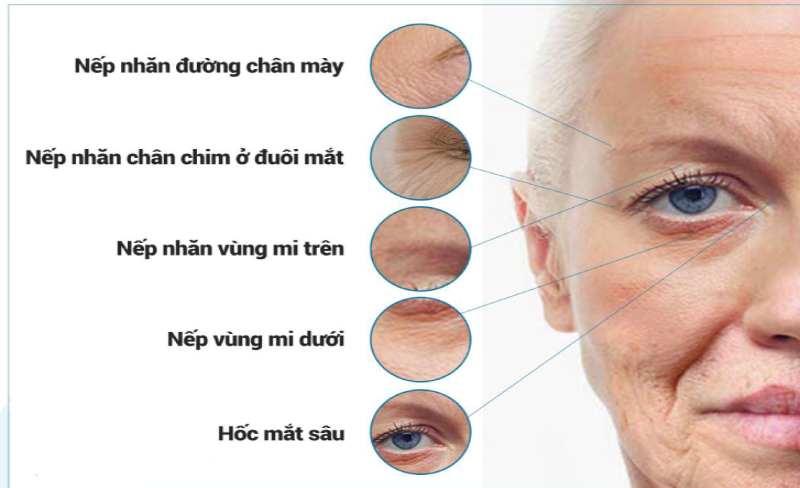 Khi cười các cơ trên gương mặt sẽ hoạt động khiến nếp nhăn mắt rõ hơn