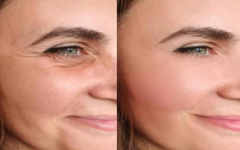 Thói quen biểu cảm mạnh trên mặt dẫn đến bị nhăn mắt dưới