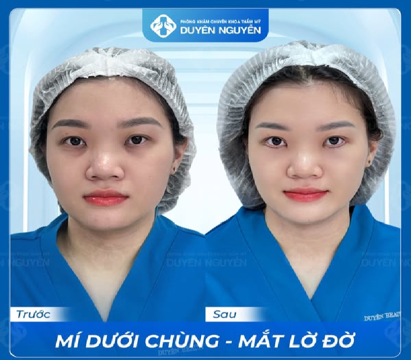 Quy trình bóc mỡ mắt nội soi an toàn, chuyên nghiệp tại phòng khám Duyên Nguyễn