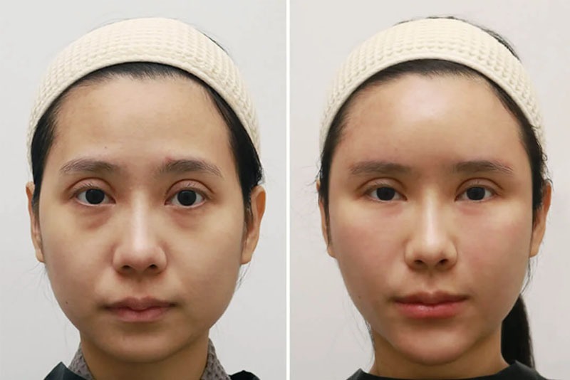Có nhiều nguyên nhên khiến cằm ngấn mỡ, gương mặt to