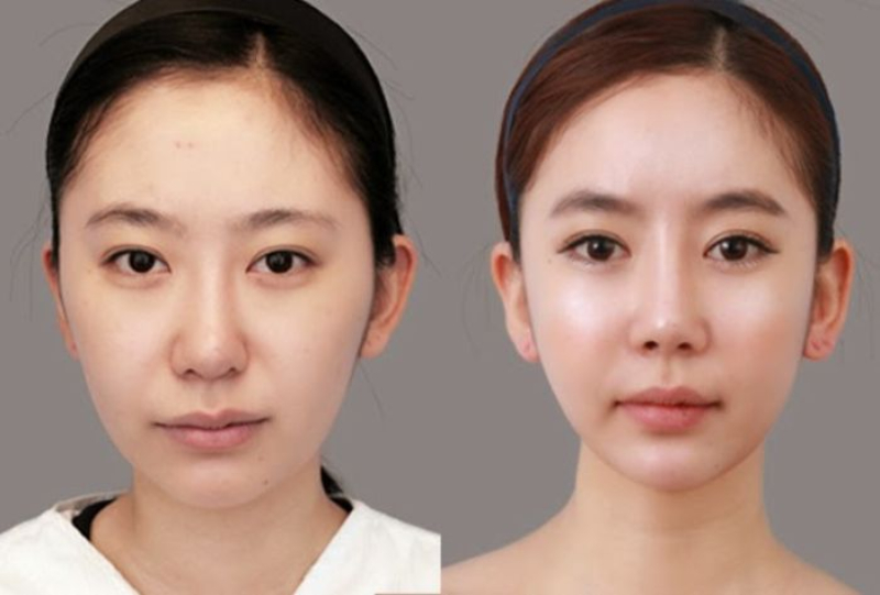 Phẫu thuật thẩm mỹ nọng cằm khoảng sau 6 tuần sẽ đẹp