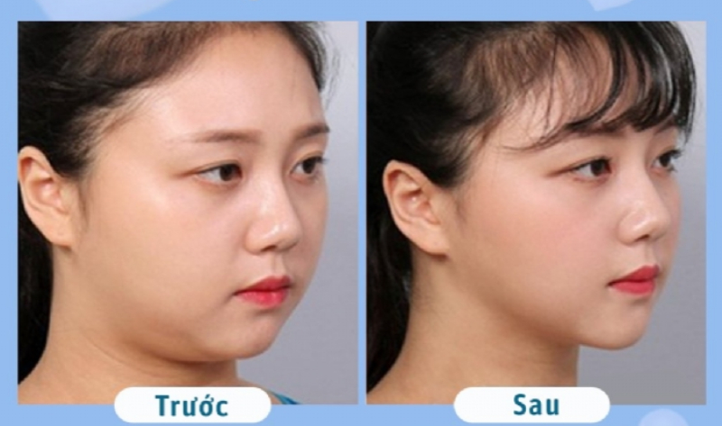 Hình ảnh khách hàng hút mỡ nọng cằm V-Line tại phòng khám Duyên Nguyễn 2