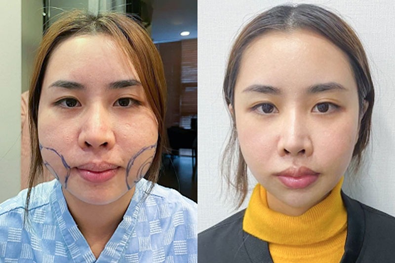 Hình ảnh khách hàng hút mỡ nọng cằm V-Line tại phòng khám Duyên Nguyễn 5