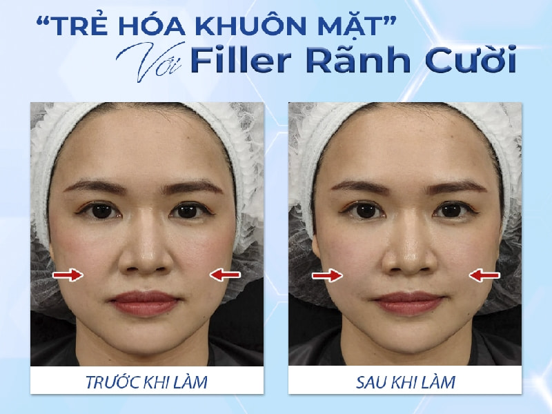Trẻ hóa với filler rãnh cười được nhiều chị em lựa chọn