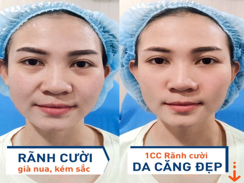 Tiêm rãnh cười giúp da căng đẹp, xóa mờ râu rồng
