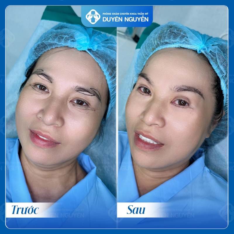 Phòng khám Duyên Nguyễn địa chỉ nâng cung mày uy tín, an toàn