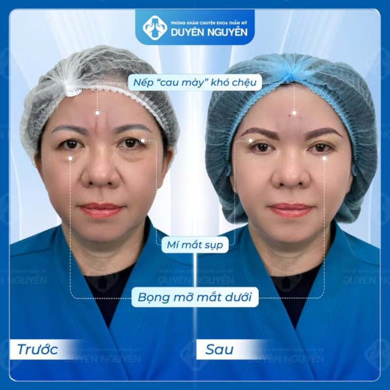 Bác sĩ sẽ đánh giá tình trạng để xác định phương pháp xử lý khi nâng cung mày hỏng