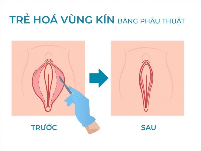 Chị em nên cân nhắc cắt môi cô bé nếu cảm thấy tự ti