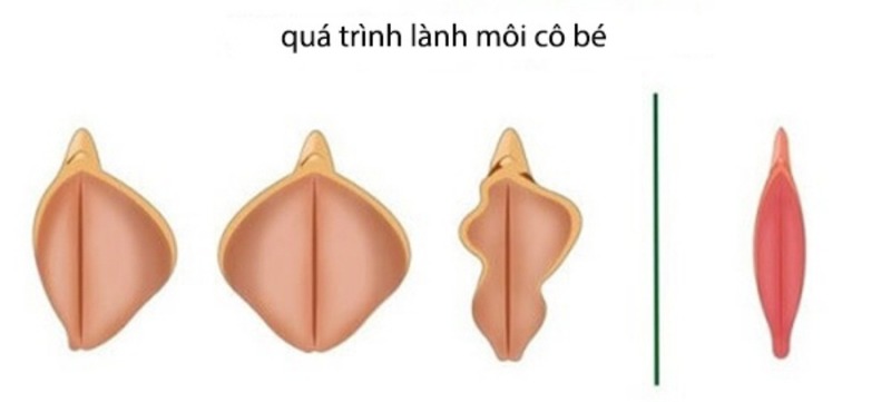 Chị em có thể an tâm sinh hoạt trở lại làm việc trở lại chỉ sau 3-4 ngày