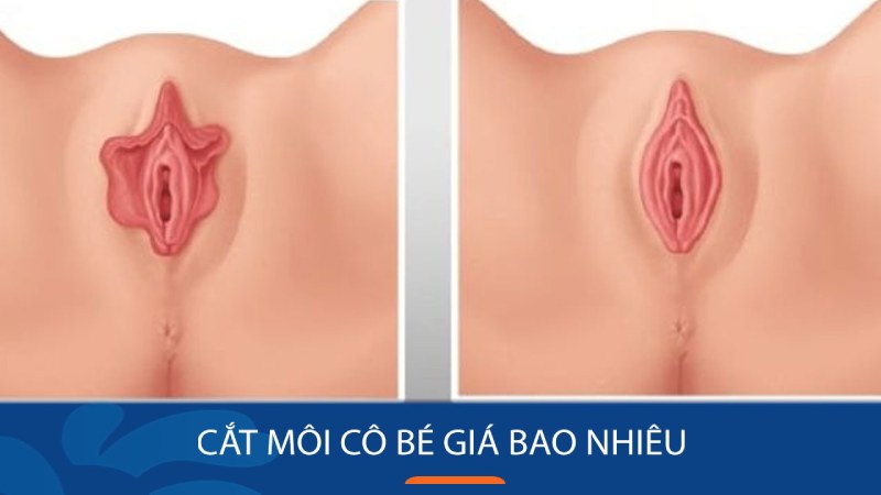 Cắt môi cô bé giá bao nhiêu