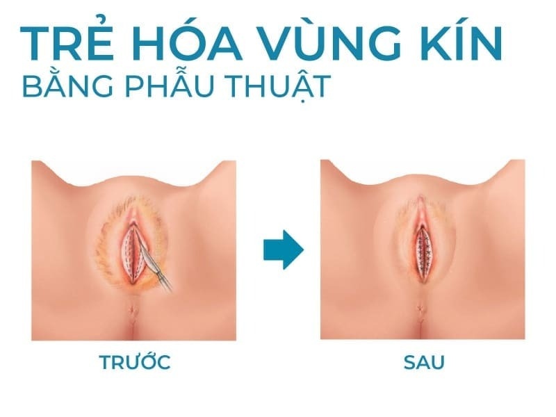 Dịch vụ cắt môi bé vùng kín