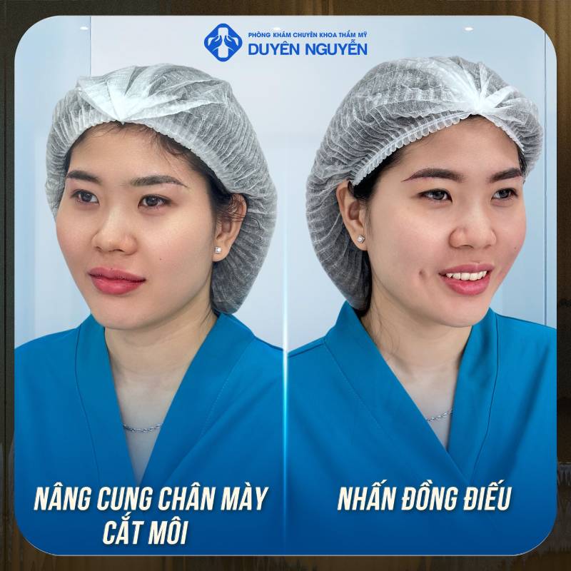 Phòng khám Duyên Duyễn địa chỉ nâng cung mày thẩm mỹ uy tín